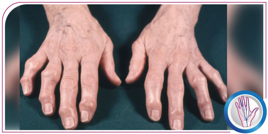 Artrosis de la mano y muñeca